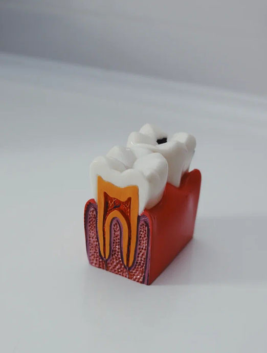 Лечение кариеса Лечение кариеса